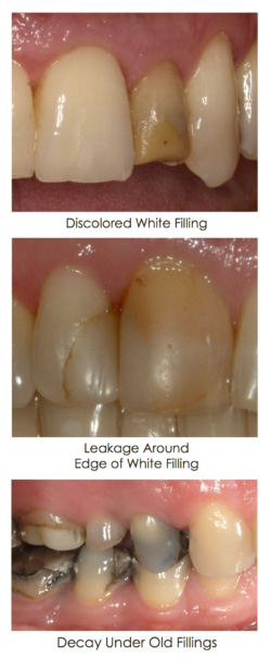 Discolored fillings displayed in set of images at Djawdan Center for Implant and Restorative Dentistry.