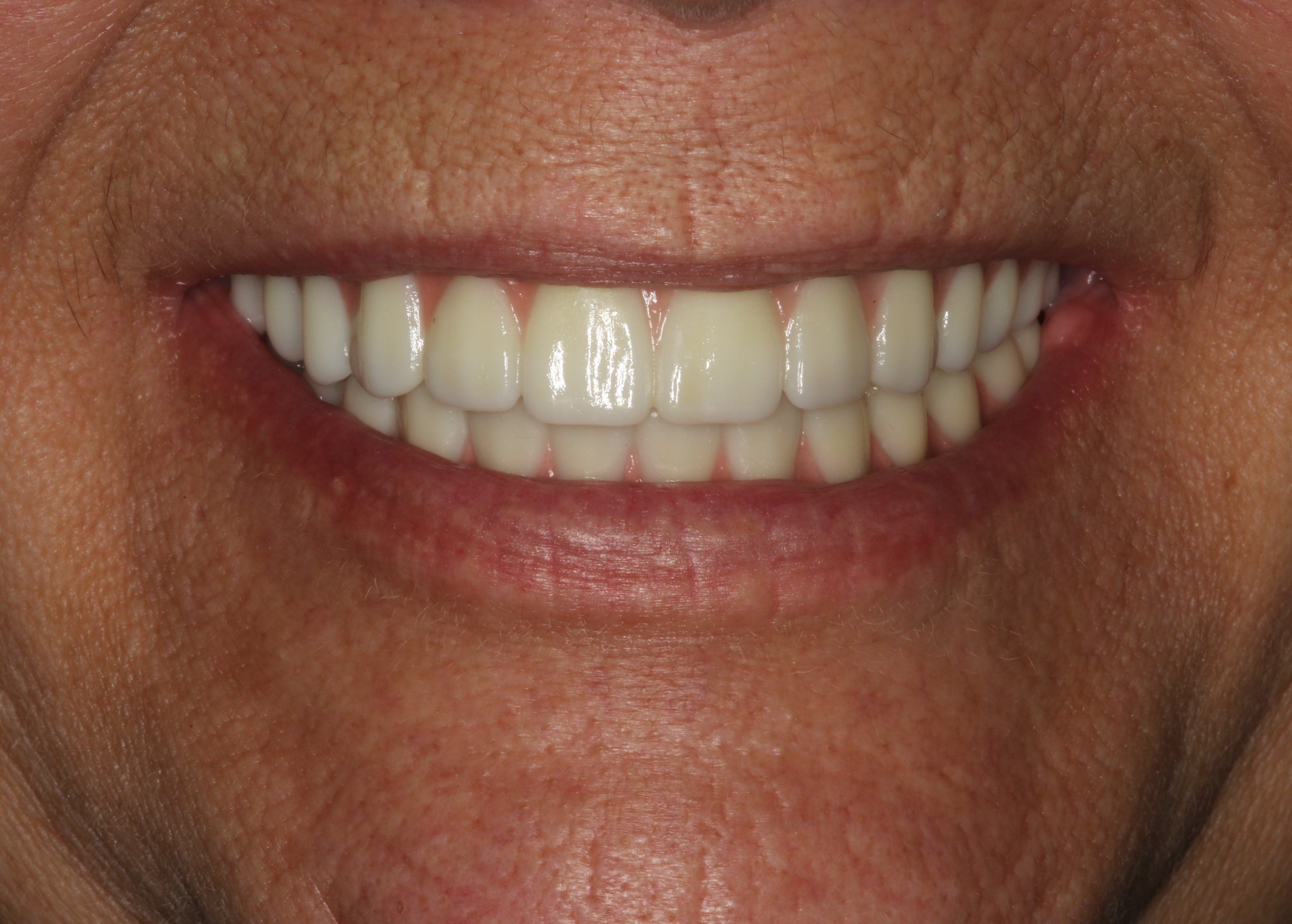 after all on 4 dental implants  travel dentistry  dental tourism  implant dentist  dental implants annapolis