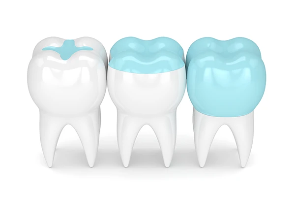 3D rendered cross-section view of three teeth with dental crowns at Djawdan Center for Implant and Restorative Dentistry in Annapolis, MD