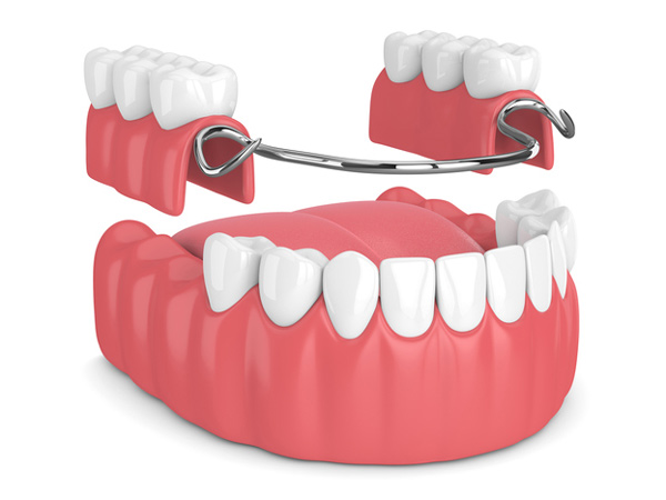 Rendering of removable partial denture at Djawdan Center for Implant and Restorative Dentistry.