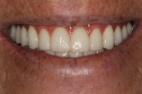 Retracted after smile at Djawdan Center for Implant and Restorative Dentistry 