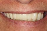 Retracted before smile at Djawdan Center for Implant and Restorative Dentistry 