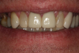 Retracted before smile at Djawdan Center for Implant and Restorative Dentistry 