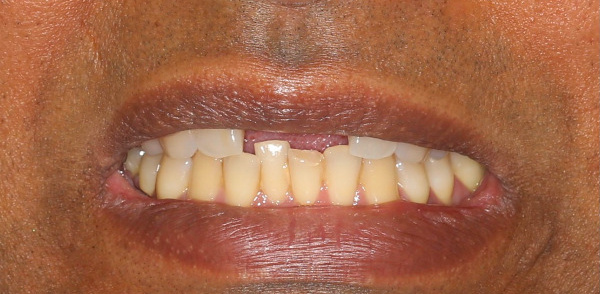 Before smile of a patient at Djawdan Center for Implant and Restorative Dentistry 