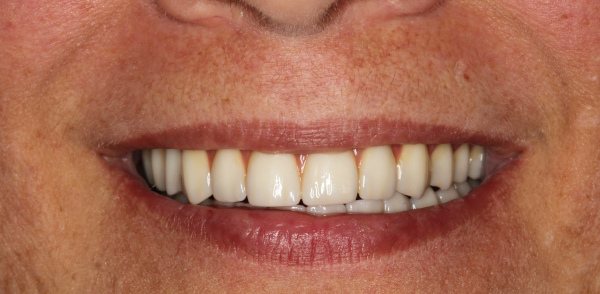 Retracted after smile at Djawdan Center for Implant and Restorative Dentistry 