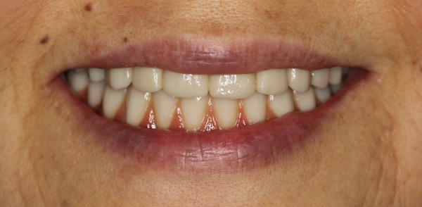 After smile of a patient at Djawdan Center for Implant and Restorative Dentistry 