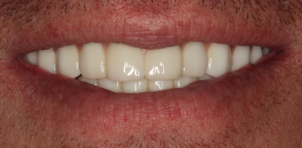 Retracted after smile at Djawdan Center for Implant and Restorative Dentistry 