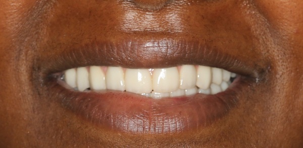 After smile of a patient at Djawdan Center for Implant and Restorative Dentistry 