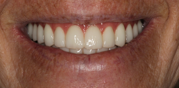 Retracted after smile at Djawdan Center for Implant and Restorative Dentistry 