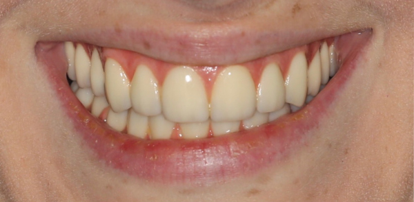 Retracted after smile at Djawdan Center for Implant and Restorative Dentistry 