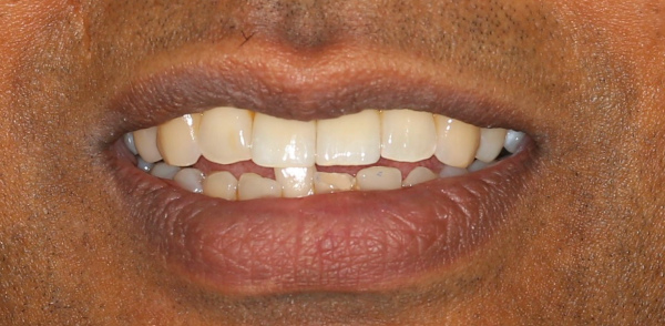 After smile of a patient at Djawdan Center for Implant and Restorative Dentistry 