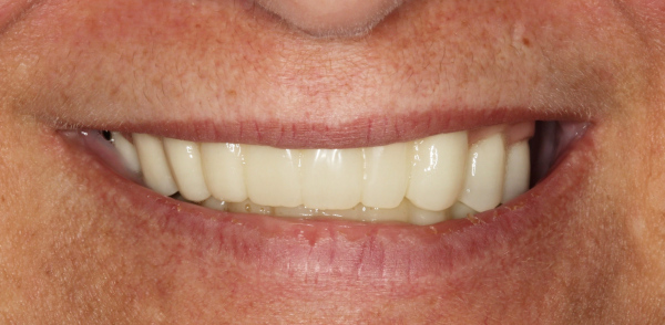 Retracted before smile at Djawdan Center for Implant and Restorative Dentistry 