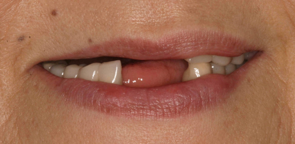 Before smile of a patient at Djawdan Center for Implant and Restorative Dentistry 