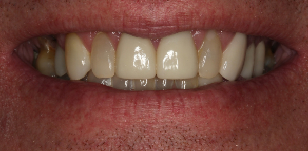 Retracted before smile at Djawdan Center for Implant and Restorative Dentistry 