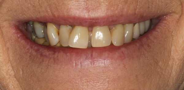 Retracted before smile at Djawdan Center for Implant and Restorative Dentistry 