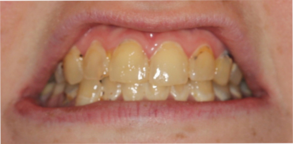 Retracted before smile at Djawdan Center for Implant and Restorative Dentistry 