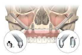 Zygomatic bone