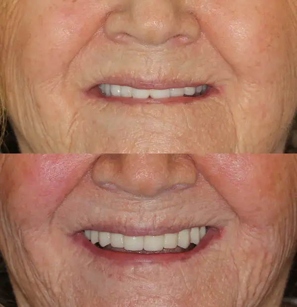 Before and After