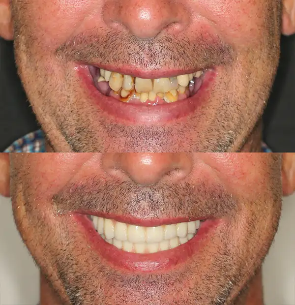 Before and After