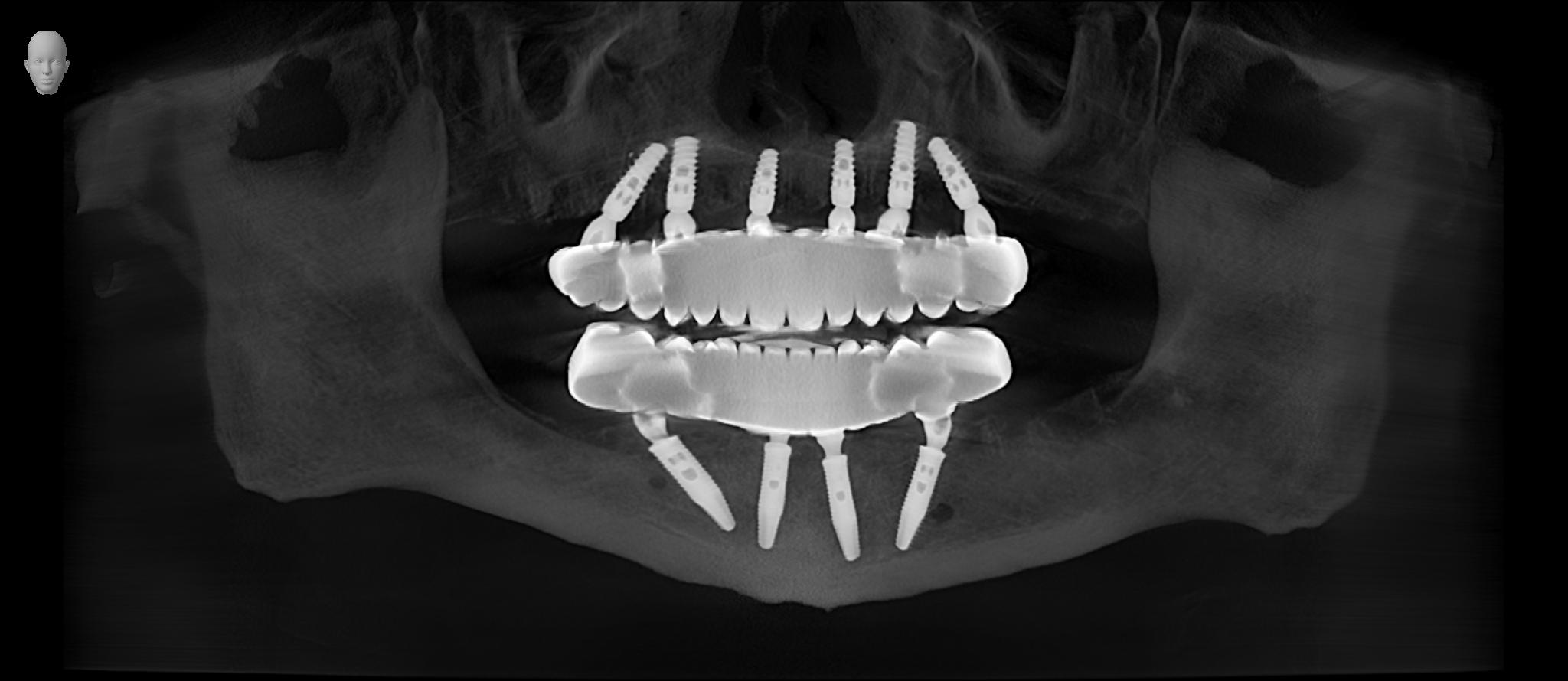 Anonymous Patient 3D examination(2) VO3 132229 Panorama