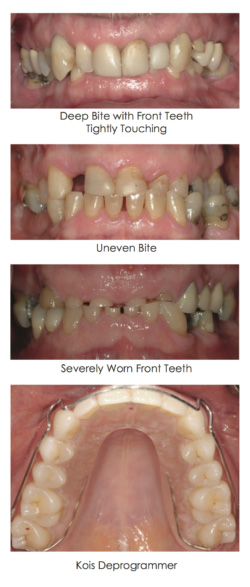 Bite Problems case displayed in the set of images at Djawdan Center for Implant and Restorative Dentistry.