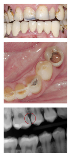 Tooth Decay cavity case study images at Djawdan Center for Implant and Restorative Dentistry 