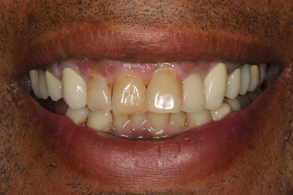 Before smile of a patient at Djawdan Center for Implant and Restorative Dentistry 