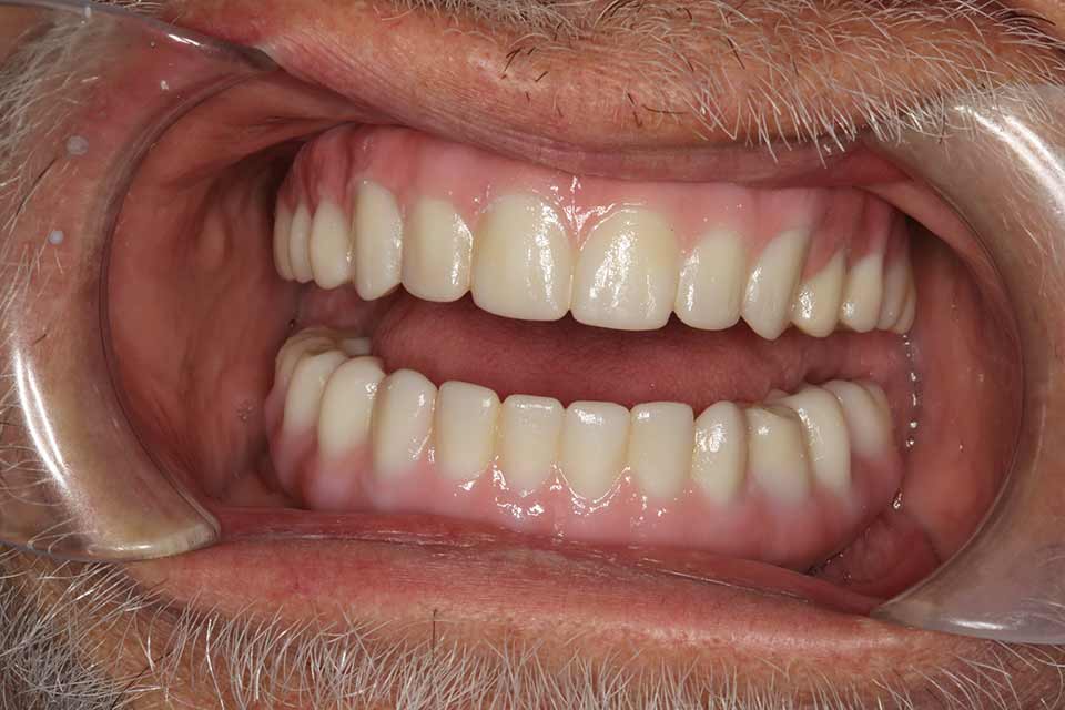 Retracted after smile at Djawdan Center for Implant and Restorative Dentistry 