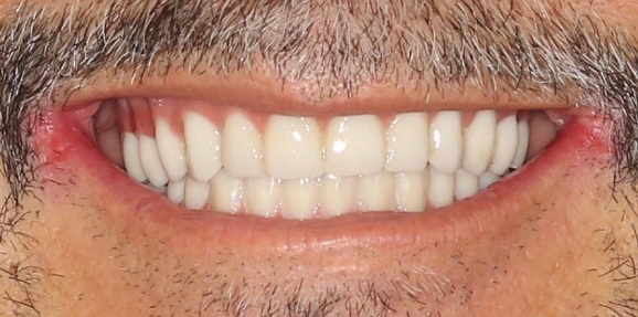 after all on 4 dental implants  implant dentist  dental implants annapolis  implants in one day