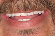 Chip's smile transformation at Djawdan Center for Implant and Restorative Dentistry.