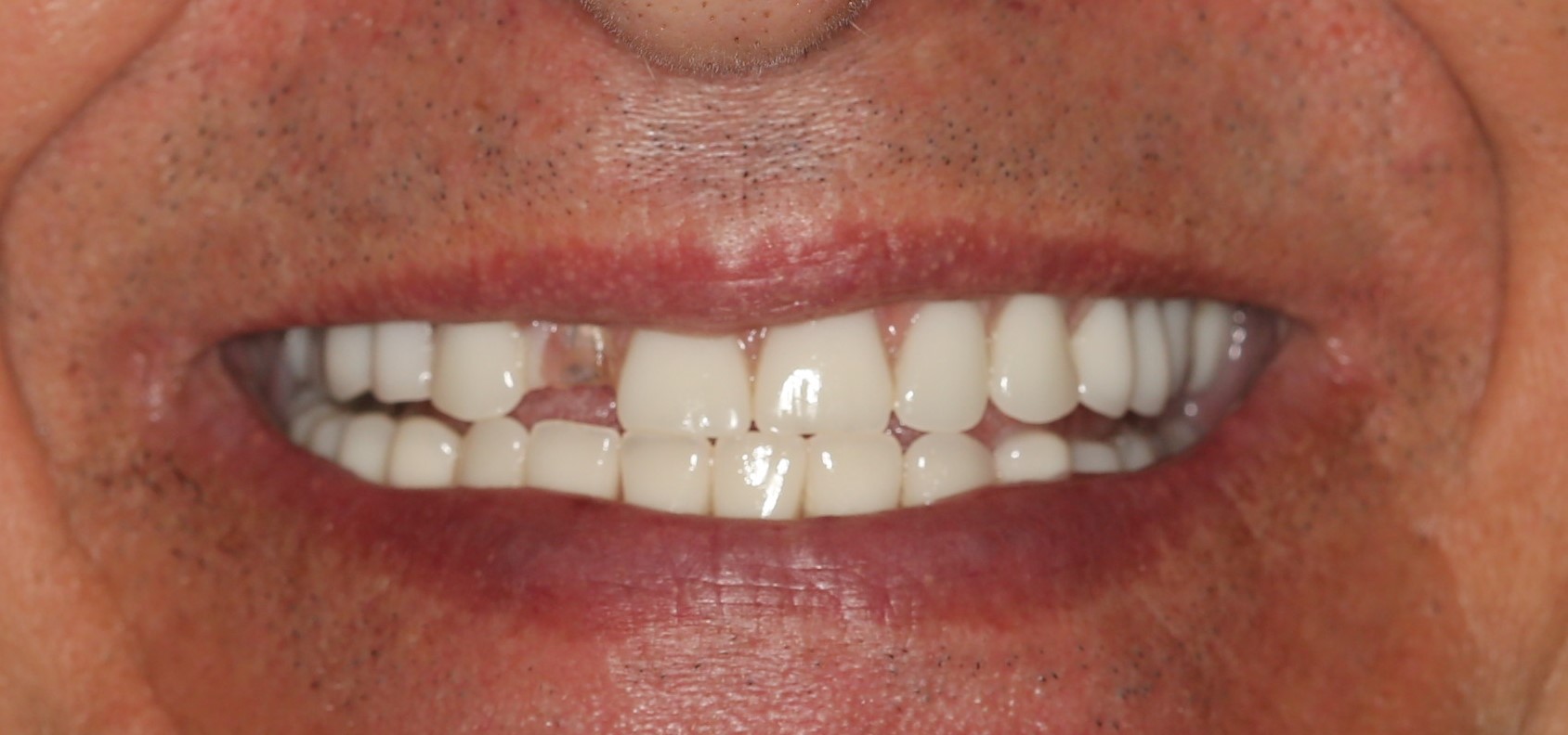 dental implants annapolis djawdan chipped tooth