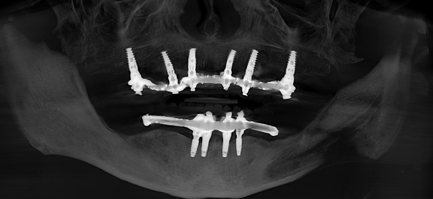 dental implants annapolis djawdan pano