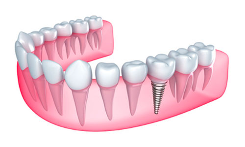 Installing a Dental Implant