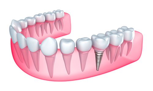 A Brief History of Dental Implants