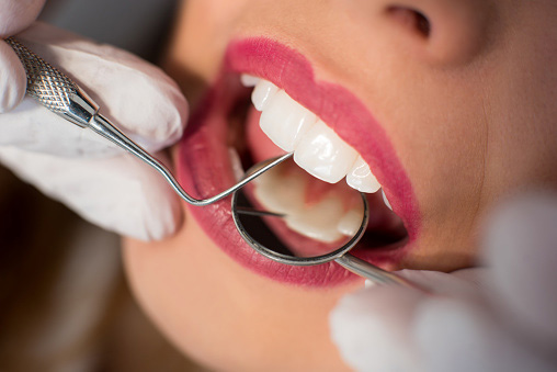 Close up of woman's teeth getting a second opinion at Djawdan Center for Implant and Restorative Dentistry in Annapolis, MD