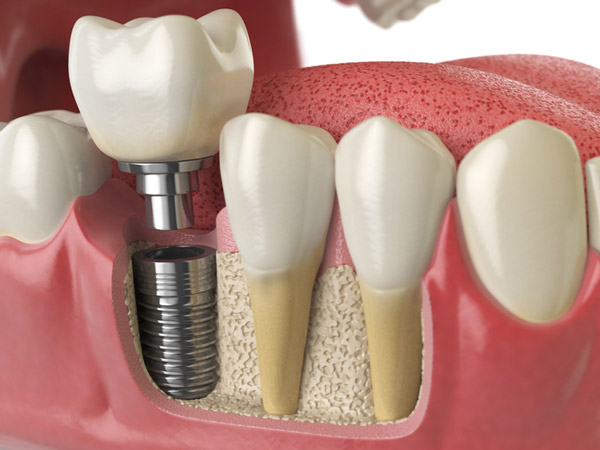 Diagram of dental implant into jaw bone at Djawdan Center for Implant and Restorative Dentistry.