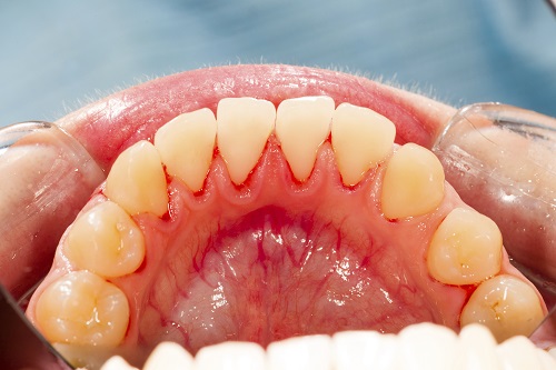How do you prevent gum disease in children